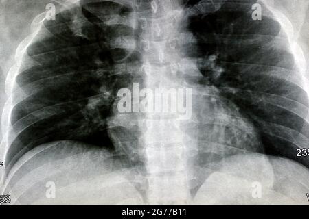 Normale Röntgenaufnahme der Brust, fast normale menschliche Röntgenaufnahme der Brust, aber mit einigen Staus, die durch Rauchen und chronische Bronchitis entstanden sind, liegt der Herzschatten innerhalb von norma Stockfoto