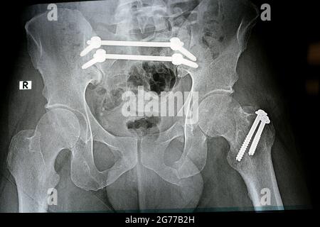 Einfaches Röntgenbild mit einem Frakturbecken, das mit 4 Schrauben und 2 Stäben befestigt ist, und Bruch eines größeren Trochanters des Oberschenkels, der mit 2 Schrauben befestigt ist Stockfoto