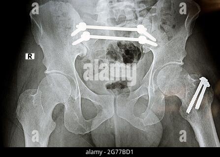 Einfaches Röntgenbild mit einem Frakturbecken, das mit 4 Schrauben und 2 Stäben befestigt ist, und Bruch eines größeren Trochanters des Oberschenkels, der mit 2 Schrauben befestigt ist Stockfoto