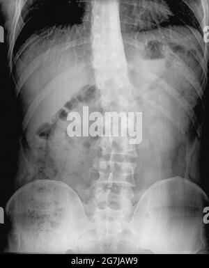 Röntgenfilm der Wirbelsäulenverkrümmung (Skoliose). Schwere medizinische Skoliose. Diagnose des Patienten mit Röntgenaufnahmen. Backbone- und Gelenkdiagnose Stockfoto