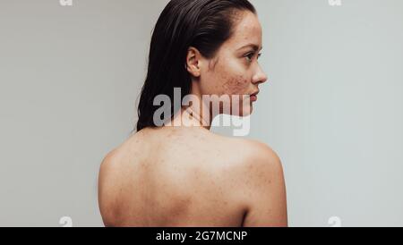 Porträt einer Frau mit Akne-Entzündung auf Gesicht und Körper. Rückansicht Nahaufnahme einer Frau mit Pickel im Gesicht. Stockfoto