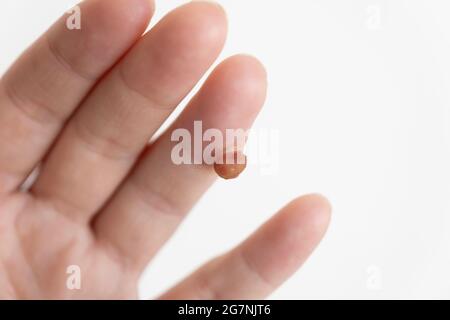 Hervorstehender Weichteiltumor im Finger auf weißem Hintergrund Stockfoto