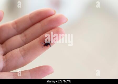 Eine Wunde am Finger einer Frau wurde mit chirurgischen Nähten behandelt. Stockfoto