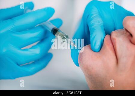 Behandlung des dermalen Füllstoffes Stockfoto