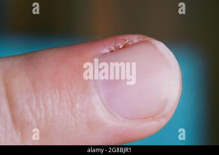 Entzündete Nagelhaut am Finger. Beschädigter Teil des Fingers, Nahaufnahme. Stockfoto