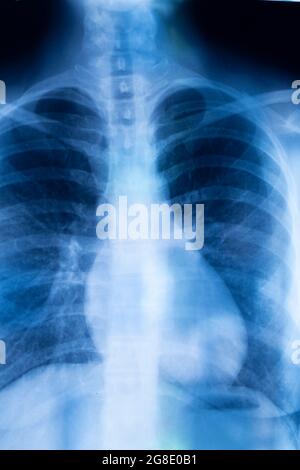 Ergebnis des Röntgenscans der Lungenrippen. Stockfoto