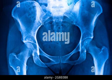 Ergebnis des Scans des Hüftbeckens. Stockfoto