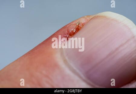 Entzündete Nagelhaut am Finger. Beschädigter Teil des Fingers, Nahaufnahme. Stockfoto