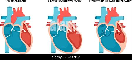 Arten von Herzerkrankungen - normale, hypertrophe und erweiterte Kardiomyopathie. Querschnittserkrankungen des menschlichen Herzmuskels. Stock Vektor