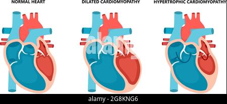 Arten von Herzerkrankungen - normale, hypertrophe und erweiterte Kardiomyopathie. Querschnittserkrankungen des menschlichen Herzmuskels. Stock Vektor