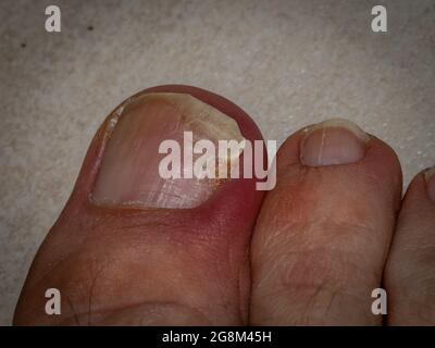 Fußzehe mit dermatologischen Problemen auf dem Nagel Stockfoto