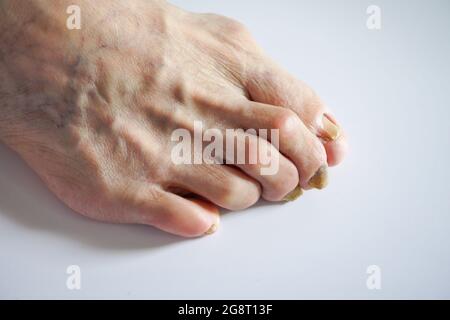 Old mans Fuß mit deformierten Zehennägeln und Pilznägeln schließen auf weißem Hintergrund - männliche Füße mit Nagelpilz und beschädigtem Zehennagel Stockfoto