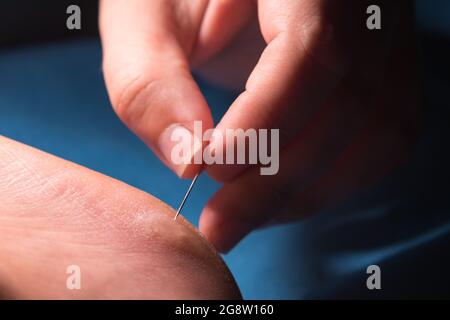 Die Finger von Frauen stechen mit einer Nadel einen Hornhaut an der Ferse. Nahaufnahme Stockfoto