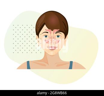 Nasenanatomie - Sinusitis - Stockillustration als EPS 10 Datei Stock Vektor