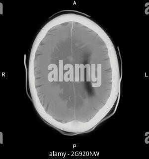 Subakutes Subdurales Hämatom Stockfoto