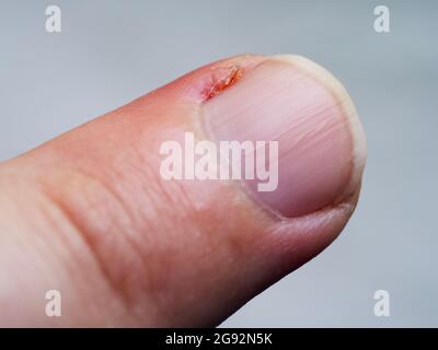 Entzündete Nagelhaut am Finger. Beschädigter Teil des Fingers, Nahaufnahme. Stockfoto