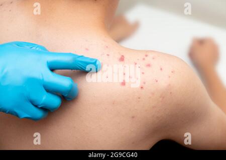 Teenager-Akne-Akne auf der Schulter eines jungen Mannes bei einem Arzttermin in einer Klinik zur Behandlung eines Problems. Stockfoto