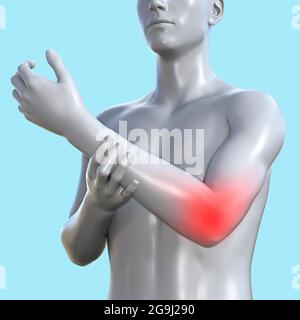 3d-Renderdarstellung einer männlichen Figur mit rot entzündeter Ellenbogenfläche auf blauem Hintergrund, traumatologisches Klinikkonzept. Stockfoto