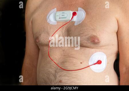 Holter Heart Monitor bei männlichen kaukasischen Patienten Thorax zur Aufzeichnung der elektrischen Aktivität des Herzens für bis zu 72 Stunden, Myokarditis Stockfoto