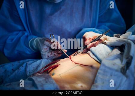 Nahaufnahme der Ärzte Hand mit medizinischen Instrumenten während der Durchführung Bauchdeckenoperation. Chirurg, der im Operationssaal eine plastische Bauchoperation durchgeführt hat. Kontra Stockfoto