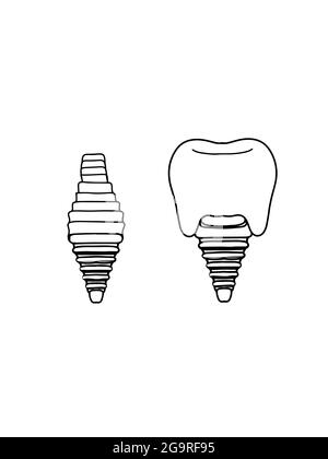 Zahnimplantate , Abbildung , Symbol. Stockfoto