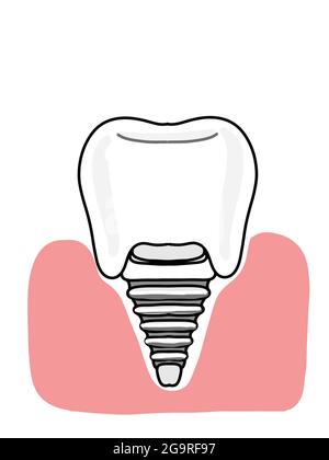 Zahnimplantate , gingivale Illustration , Symbol. Stockfoto