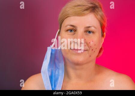 Das Nahaufnahme-Bild einer älteren Frau mit zurückgezogenem Haar, das Akne hatte, nachdem sie die medizinische Maske lange Zeit in einer Pandemie getragen hatte. Stockfoto