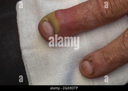 Geschwollene Finger einer Hand aufgrund dermatologischer Infektion durch einen eitergefüllten Fingernagel und infektiöse Bakterien Gesundheitskonzept Stockfoto