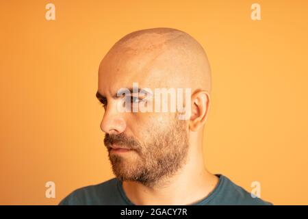 Ein gebräunter kaukasischer Mann mit rasiertem Kopf hat ein Problem damit, dass sich die Haut auf seinem Kopf aufgrund von Sonnenbrand und zu viel Sonneneinstrahlung ablöst Stockfoto