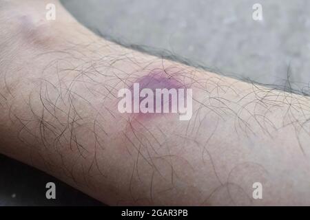 Bluterguss im rechten Bein eines asiatischen burmesischen Patienten. Seitenansicht. Stockfoto