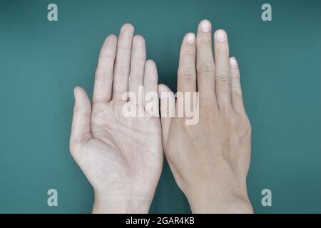 Blasse Palmaroberfläche beider Hände. Anämische Hände eines asiatischen, chinesischen Mannes. Isoliert auf grünem Hintergrund. Stockfoto