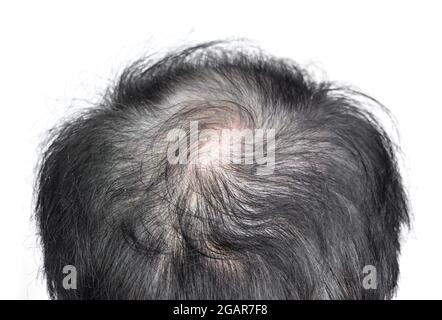 Dünner werdendes oder spärliches Haar, Haarausfall nach männlichem Muster im südostasiatischen, chinesischen älteren Mann. Isoliert auf Weiß. Stockfoto