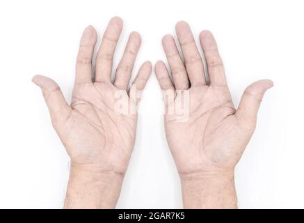 Blasse Palmaroberfläche beider Hände. Anämische Hände eines asiatischen, chinesischen Mannes. Isoliert auf weißem Hintergrund. Stockfoto