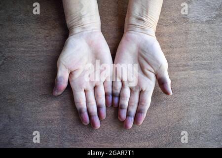 Zyanotische Hände oder periphere Zyanose oder blaue Hände bei südostasiatischer, chinesischer alter Frau mit angeborenem Herzfehler. Stockfoto