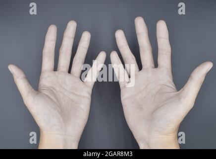 Blasse Palmaroberfläche beider Hände. Anämische Hände eines asiatischen, chinesischen Mannes. Isoliert auf grauem Hintergrund. Stockfoto