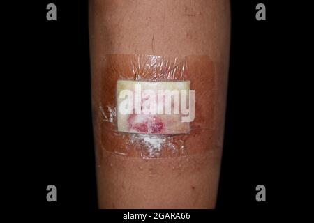 Nicht absorbierende Insel Wundverband Verband der Wunde aufgrund von versehentlicher Verletzung am Bein und der asiatischen, birmanischen erwachsenen Mann in der Klinik von Myanmar Stockfoto
