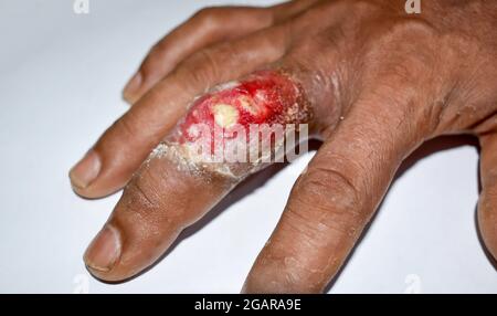 Schmerzhafter Karbunkel oder Abszess mit umgebender Cellulitis oder Staphylokokken-/Streptokokken-Hautinfektion am Mittelfinger des asiatischen burmesischen männlichen Paties Stockfoto