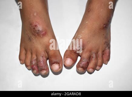 Krätze Befall mit sekundären oder überlagerten bakteriellen Infektionen und Pusteln im Fuß des südostasiatischen, burmesischen Babys. Eine ansteckende Haut condit Stockfoto