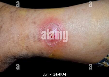 Drohender Abszess mit umgebender Cellulitis oder Staphylokokken-/Streptokokken-Hautinfektion am rechten Bein eines asiatischen burmesischen Patienten. Nahaufnahme. Ist Stockfoto