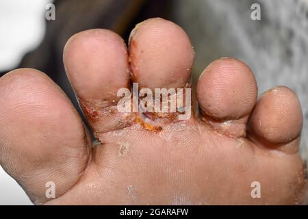 Krätze Befall mit sekundärer oder Pilzinfektion oder Tinea pedis am Fuß des südostasiatischen Mannes. Eine ansteckende Hauterkrankung, die durch Milben verursacht wird. Stockfoto