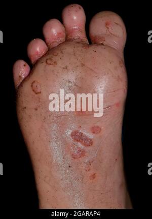 Krätze Befall mit sekundärer oder Pilzinfektion oder Tinea pedis am Fuß des südostasiatischen Mannes. Isoliert auf schwarzem Hintergrund Stockfoto
