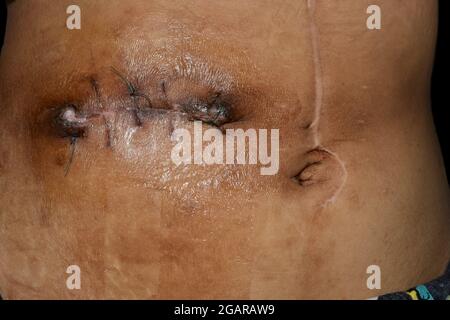 Unordentliche Kocher-Inzision oder subkostaler oder schräger Inzision für offene Cholecystektomie. Es wird auch für die Chirurgie der Leber und Gallenwege getan. Stockfoto