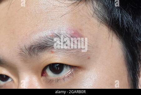 Akne Mechanica oder Sport-induzierte Akne oder Whiteheads oder milde Akne am Augenbrauenbereich des Gesichtes in Südostasien, chinesischer junger Mann. Stockfoto