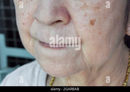 Alternde Hautfalten oder Hautfalten oder Falten und große Poren im Gesicht einer älteren, südostasiatischen chinesischen Frau. Stockfoto