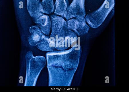 Radiographische Untersuchung der Radiusfraktur. Röntgen-Arm. Röntgenaufnahme von Handknochen. Medizintechnik-Radiographie. Röntgenfilm. Stockfoto