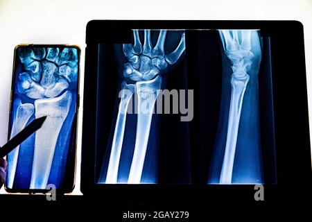 Radiographische Untersuchung der Radiusfraktur mit Mobiltelefon. Röntgen-Arm. Röntgenaufnahme von Handknochen. Medizintechnik-Radiographie. Röntgenfilm. Stockfoto