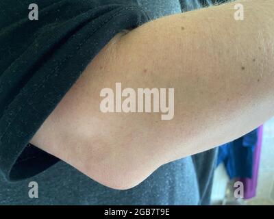 Olecranon Bursitis wird manchmal als „Popeye-Ellenbogen“ bezeichnet. Bursitis ist eine Schwellung der Bursitis Sack hier am Ellbogen auch bekannt als Tennis Ellenbogen Stockfoto