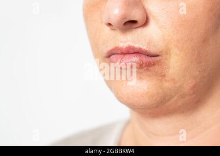 Junge Frau, die an Herpes auf ihren Lippen leidet. Konzept Hautproblem, Allergie und Dermatologie. Hochwertige Fotos Stockfoto