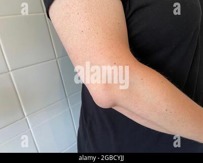 Olecranon Bursitis wird manchmal als „Popeye-Ellenbogen“ bezeichnet. Bursitis ist eine Schwellung der Bursitis Sack hier am Ellbogen auch bekannt als Tennis Ellenbogen Stockfoto