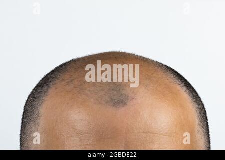 Kopf des reifen Mannes mit dünnem Haar. Haarausfall oder Transplantation Hintergrund. Glatze. Vor und nach Haarausfall Hintergrund. Speicherplatz kopieren. Isoliert auf Weiß Stockfoto